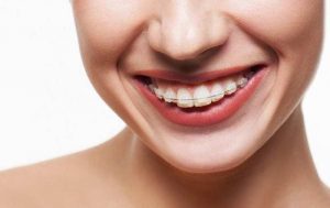 mắc cài tự đóng và mắc cài thường