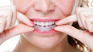 Niềng Invisalign là gì? Chi phí và hiệu quả điều trị ra sao?