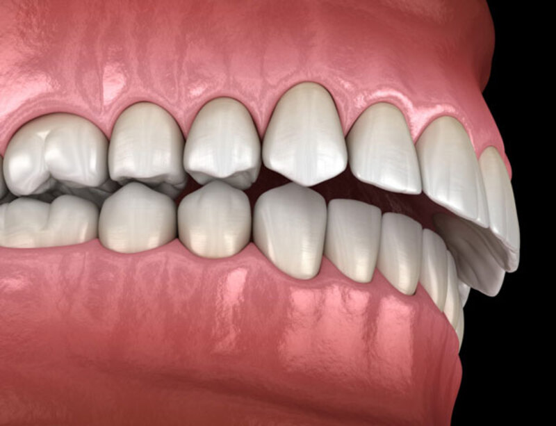 Niềng răng hô bằng nhựa ngoài những ưu điểm còn có những nhược điểm khác