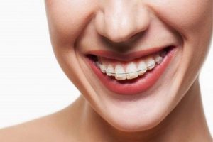 Niềng răng hô bằng nhựa