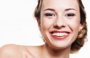 Niềng răng hô trong bao lâu? Hiệu quả không? Những điều cần biết