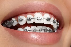 Niềng răng khớp cắn sâu
