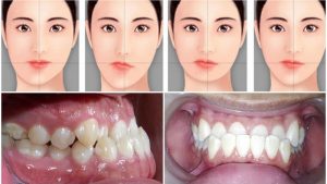 Niềng răng lệch khớp cắn