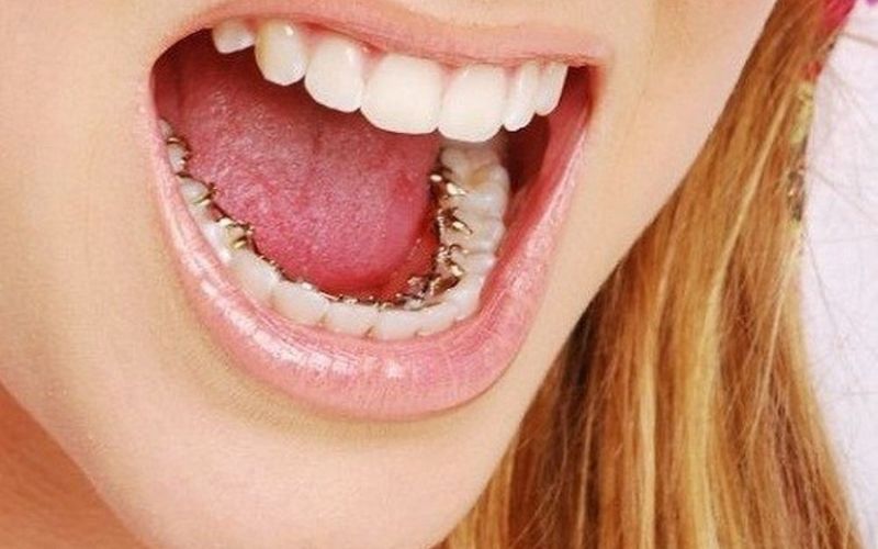 Phương pháp này có tính thẩm mỹ rất cao