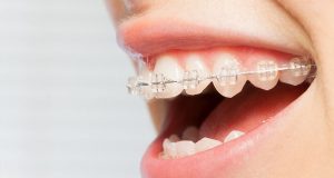 Niềng răng mắc cài sứ