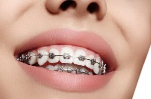 Niềng răng sắt