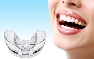 Niềng răng Trainer có thể dùng cho người trưởng thành