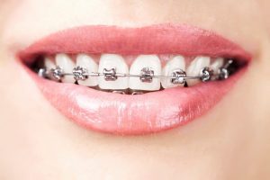 Tác hại của niềng răng sẽ rất rõ rệt nếu bạn đang gặp các vấn đề về răng miệng