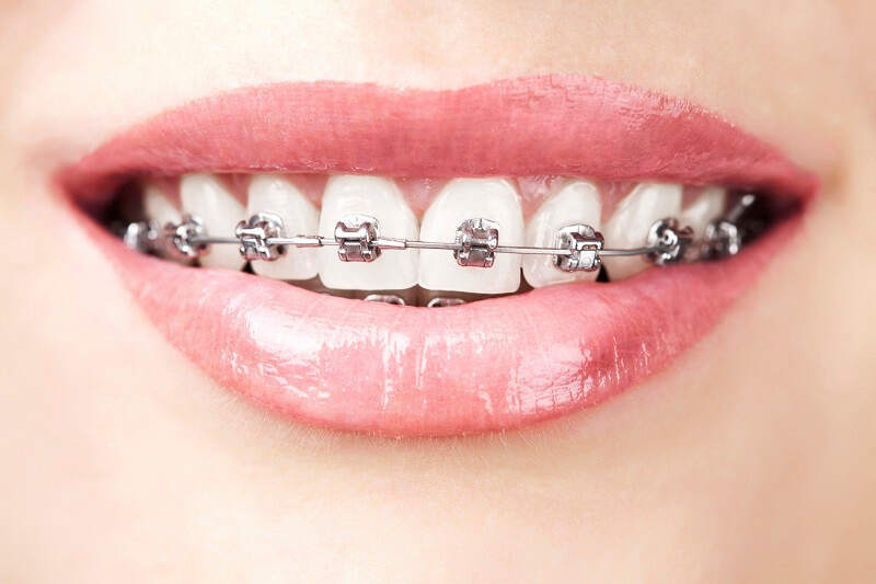 Niềng răng gây ra những cơn đau nhức ở giai đoạn đầu