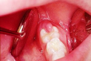Áp xe răng khôn và những tác hại không ngờ đến