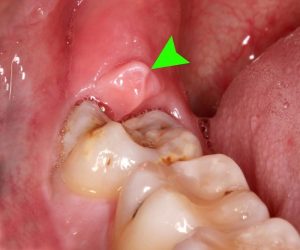 Áp xe răng 7 nếu được điều trị kịp thời sẽ hoàn toàn chữa khỏi