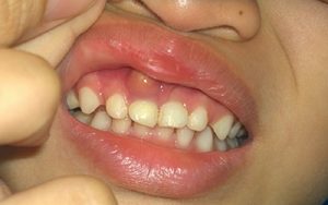 Bé bị viêm nha chu: Những thông tin cần biết cho cha mẹ