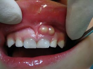 áp xe răng ở trẻ em