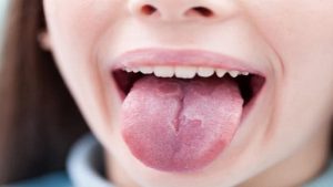 cách chữa nấm lưỡi bản đồ