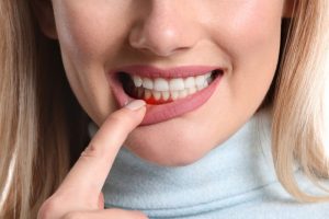 Chữa viêm nha chu ở đâu tốt tại Hà Nội và Thành phố Hồ Chí Minh?