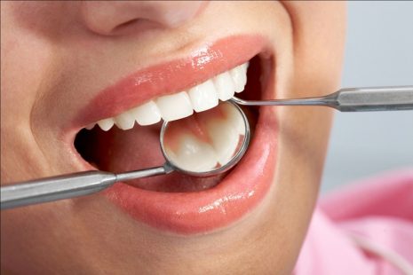 ê buốt răng sau khi trám