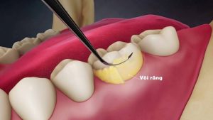 Nguyên nhân gây ê răng sau khi cạo vôi và cách khắc phục hiệu quả