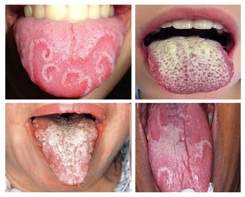 Một số hình ảnh về nấm lưỡi bản đồ