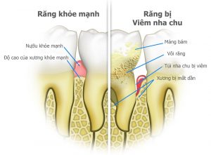 Bệnh viêm nha chu với các triệu chứng dễ nhìn thấy