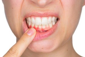 Viêm nha chu nên ăn gì và không nên ăn gì để hỗ trợ điều trị?