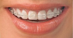 Bảng giá niềng răng mắc cài pha lê hiện nay là bao nhiêu?