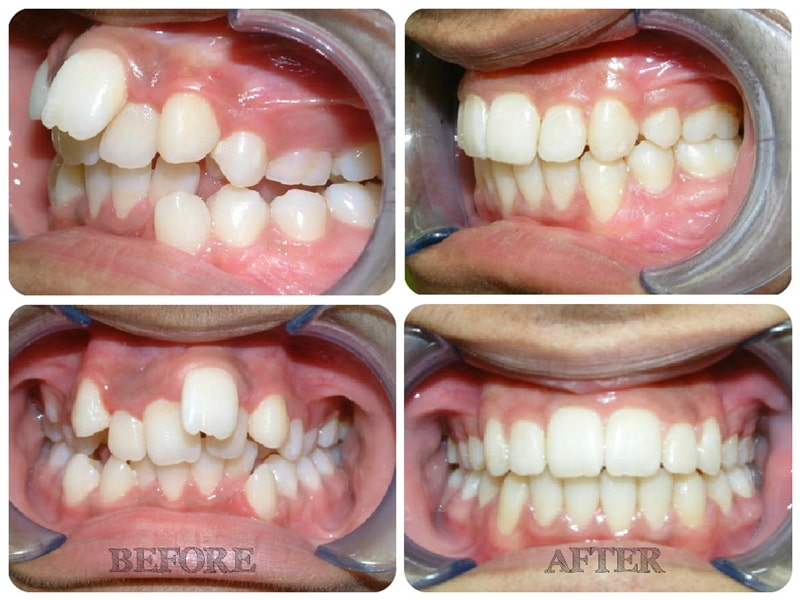 Niềng răng khấp khểnh bao nhiêu tiền sẽ phụ thuộc vào nhiều yếu tố.