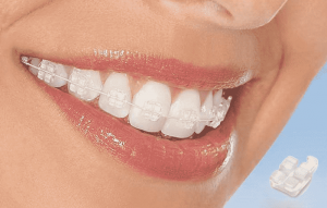 Niềng răng mắc cài sứ dây trong có thực sự hiệu quả không?