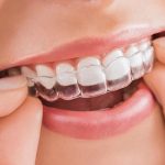 niềng răng ở đâu uy tín