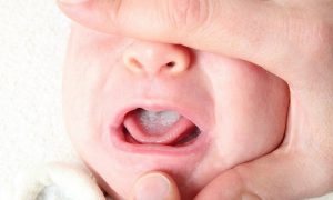 trẻ bị nấm miệng phải làm sao