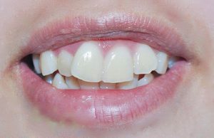 Bọc răng sứ cho răng hô có nên không? Quy trình và chi phí ra sao? 