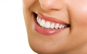Bọc răng sứ cho răng khểnh