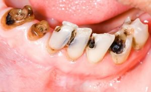 Bọc răng sứ cho răng sâu: Quy trình, chi phí