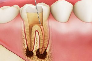 Bọc răng sứ có phải lấy tủy không là thắc mắc của rất nhiều độc giả