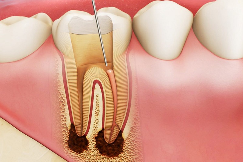 Bọc răng sứ có phải lấy tủy không là thắc mắc của rất nhiều độc giả