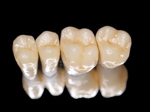 Bọc răng sứ Titan: Một số thông tin bạn cần biết