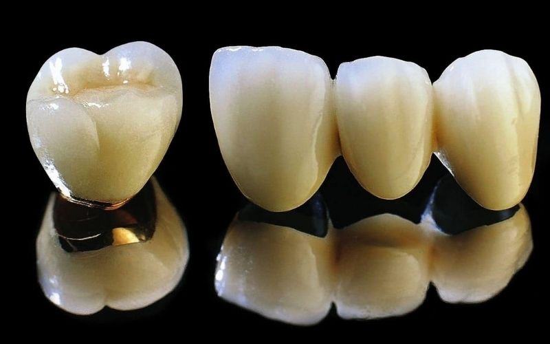 Bọc sứ răng cửa giá bao nhiêu là vấn đề khiến nhiều người quan tâm
