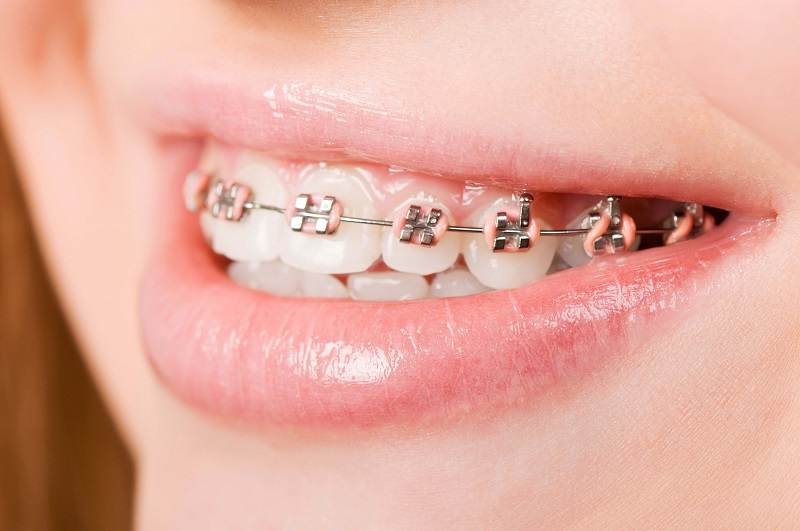 Mất răng số 6 bạn vẫn có thể niềng răng một cách bình thường được