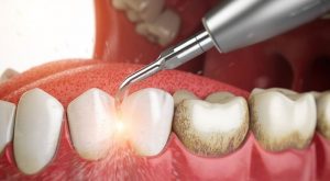 Giải đáp từ bác sĩ có nên lấy cao răng không?