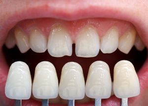 Dán Veneer là gì? Đối tượng, ưu nhược điểm, quy trình thực hiện 