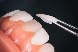 Phương pháp dán răng sứ