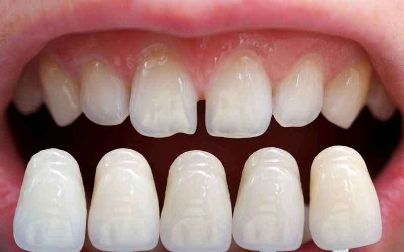 Mặt dán sứ Veneer mang đến tính thẩm mỹ cho hàm răng của bạn