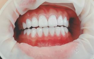Mặt dán sứ veneer giá bao nhiêu