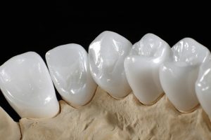 Nên bọc răng sứ loại nào tốt nhất hiện nay