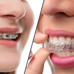 Niềng răng nhổ răng số 5