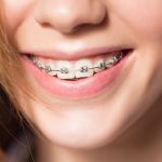 Niềng răng nhổ răng số 6 có đau không, bị ảnh hưởng gì không?