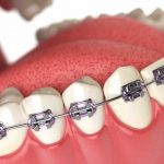 Niềng răng nhổ răng số 8 nên hay không? Giải đáp chi tiết