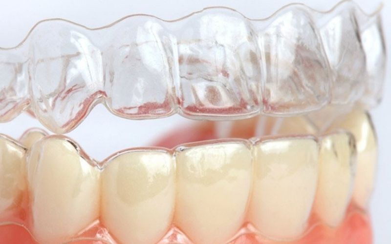 Phương án tối ưu đảm bảo tính thẩm mỹ khi chỉnh nha