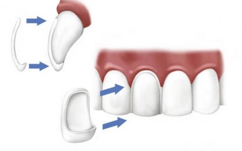 Quy trình dán sứ Veneer