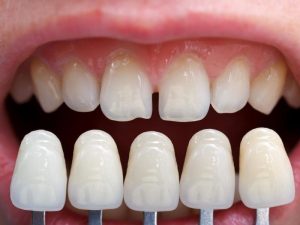 Răng sứ veneer