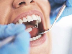 tuổi thọ của răng sứ